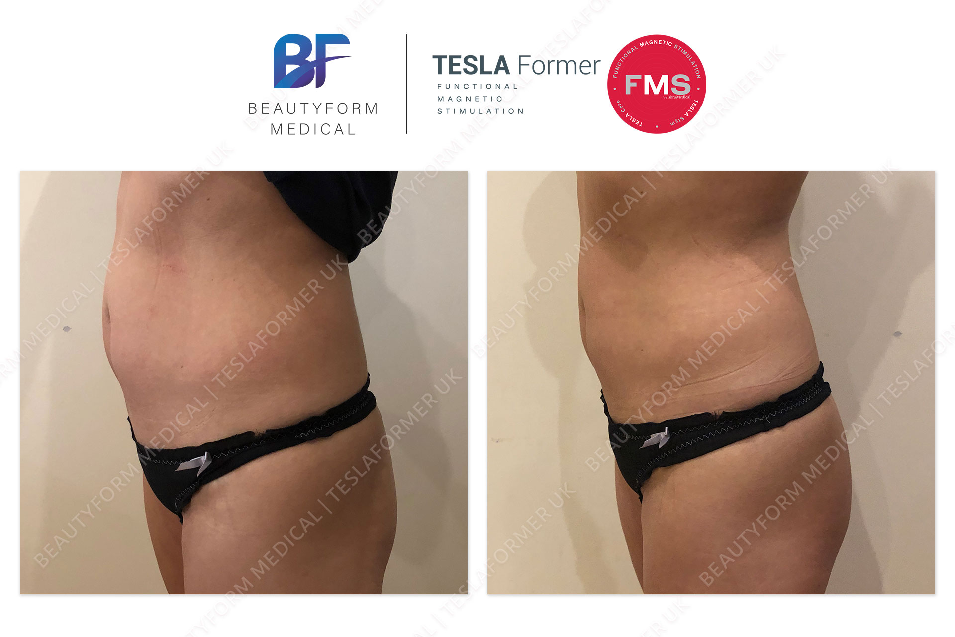 Tesla Former Abs Before and After