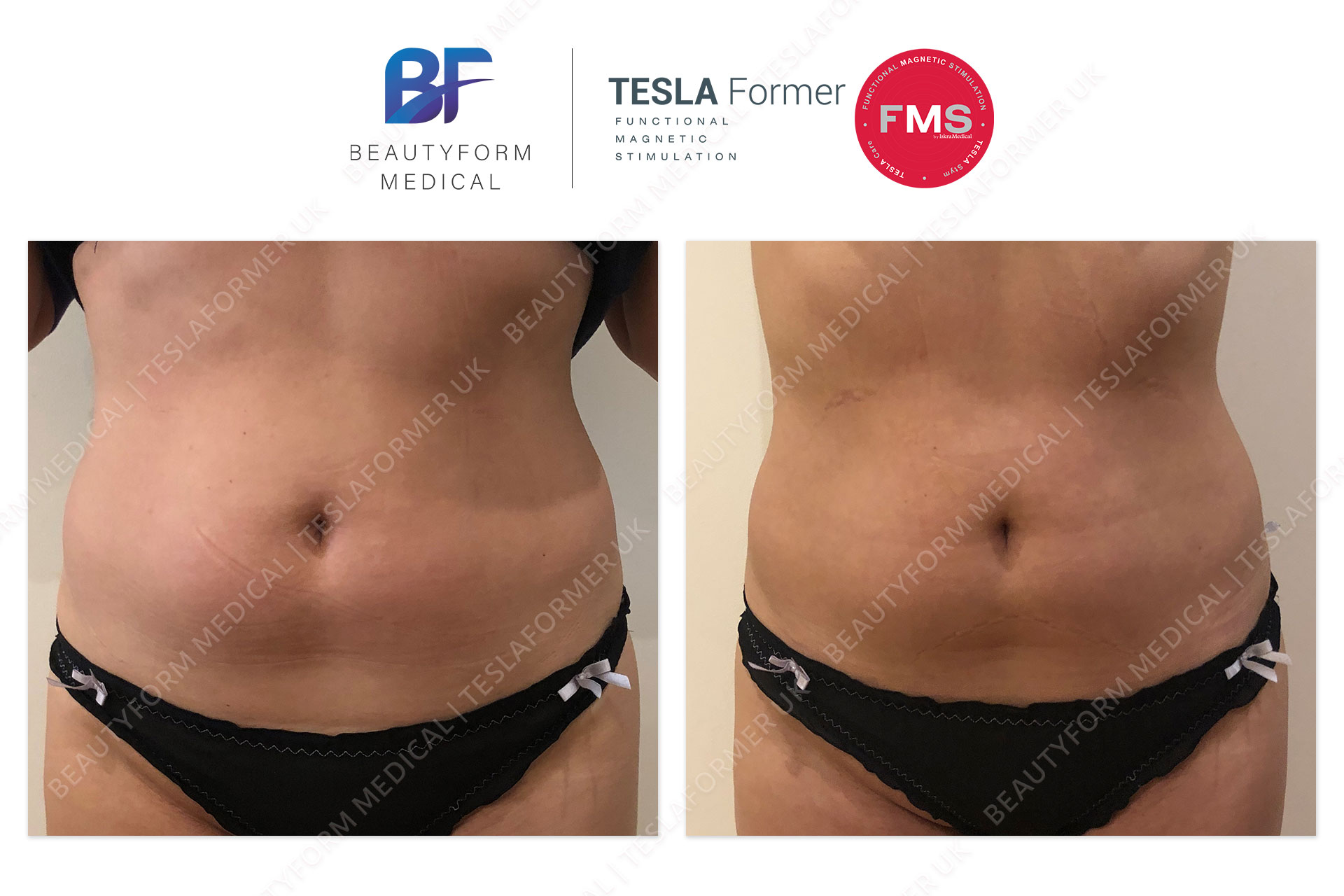 TeslaFormer Buttocks Before and After