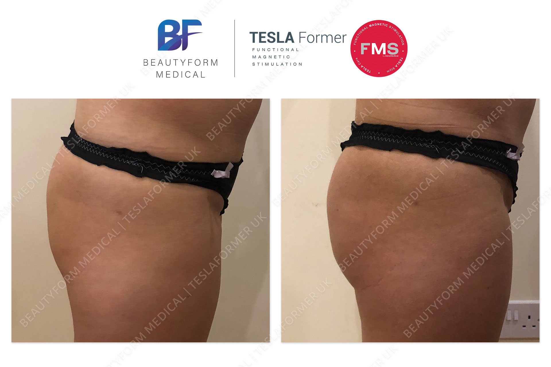 TeslaFormer Buttocks Before and After