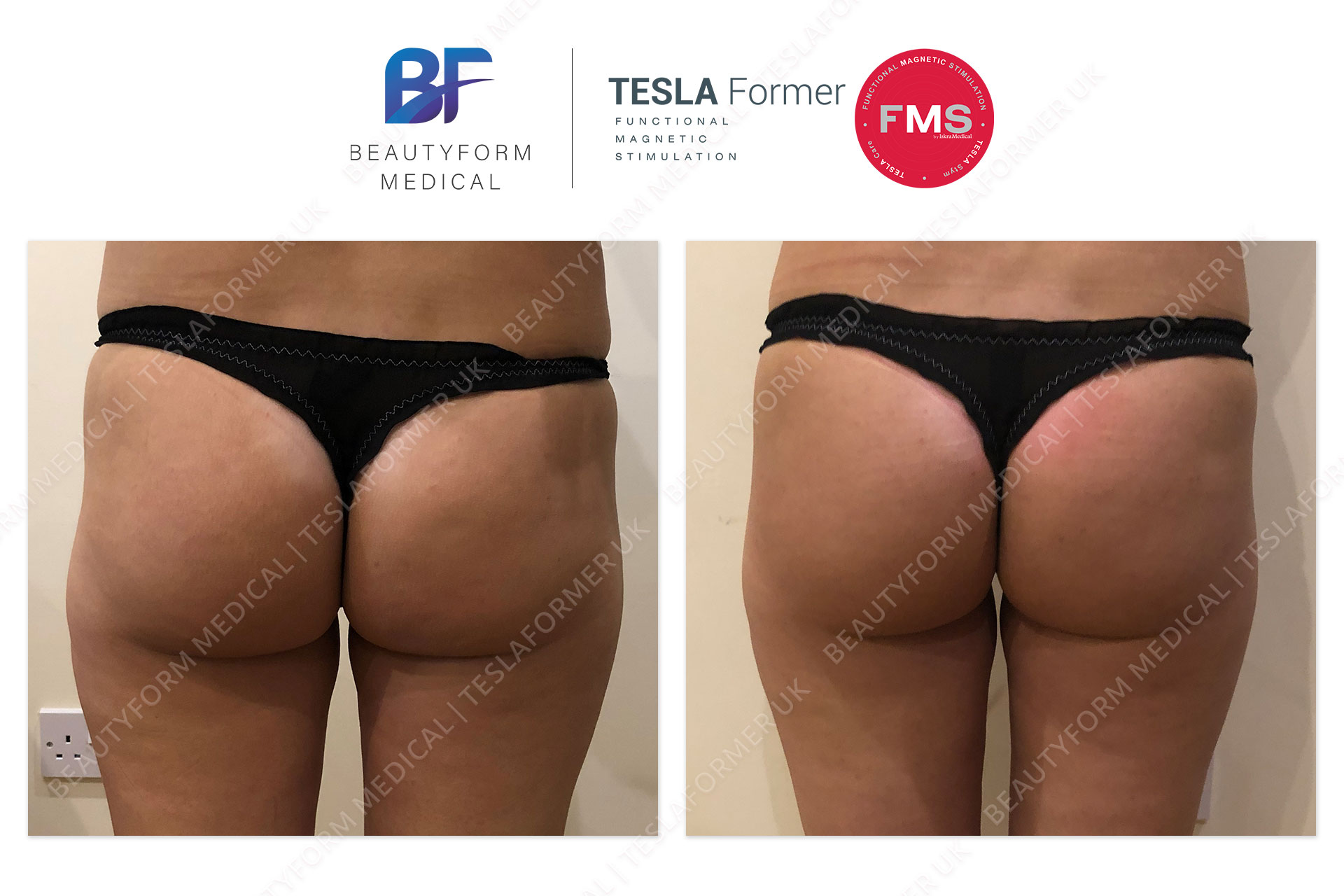 TeslaFormer Buttocks Before and After
