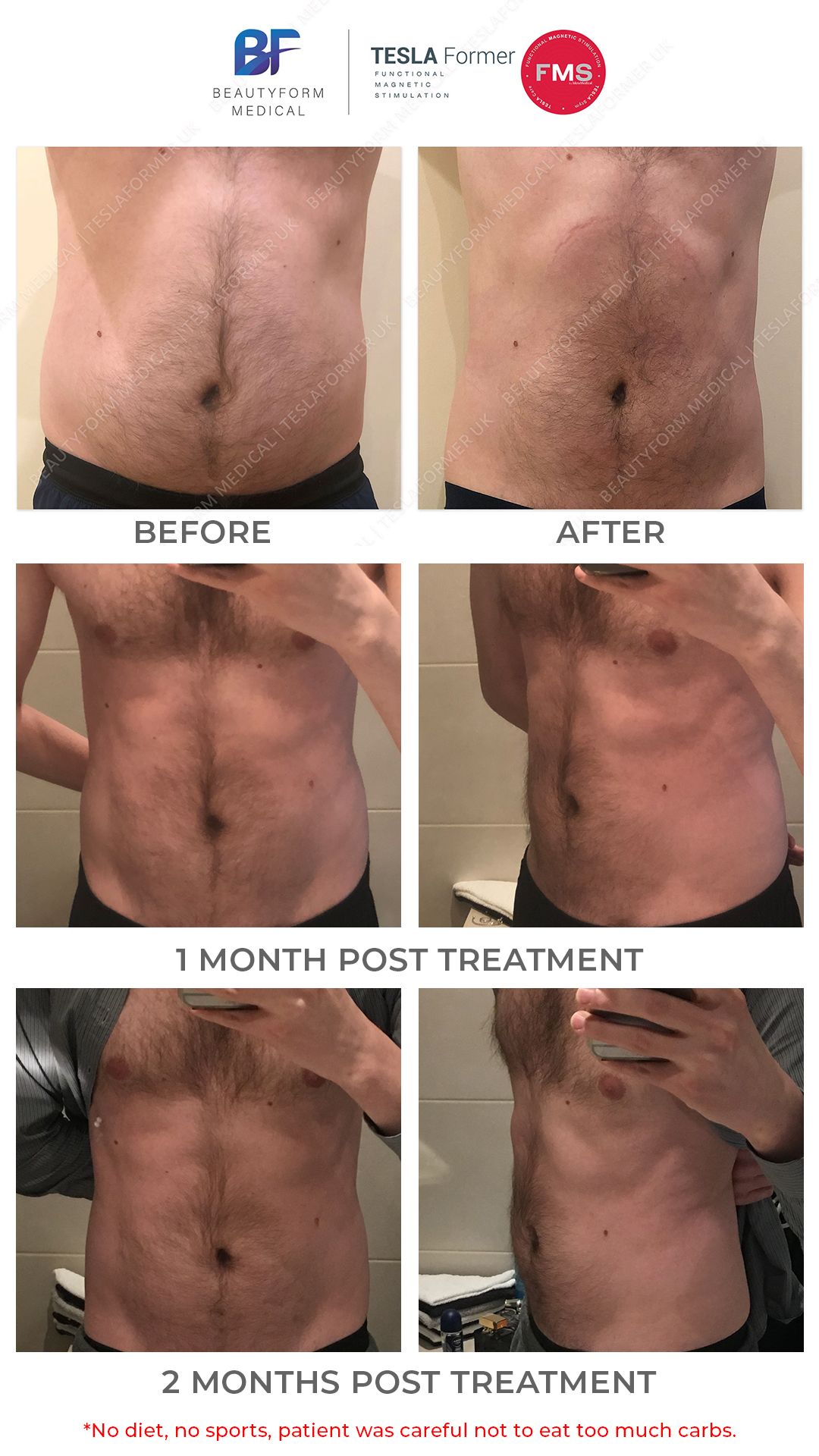 TeslaFormer abs Before and After