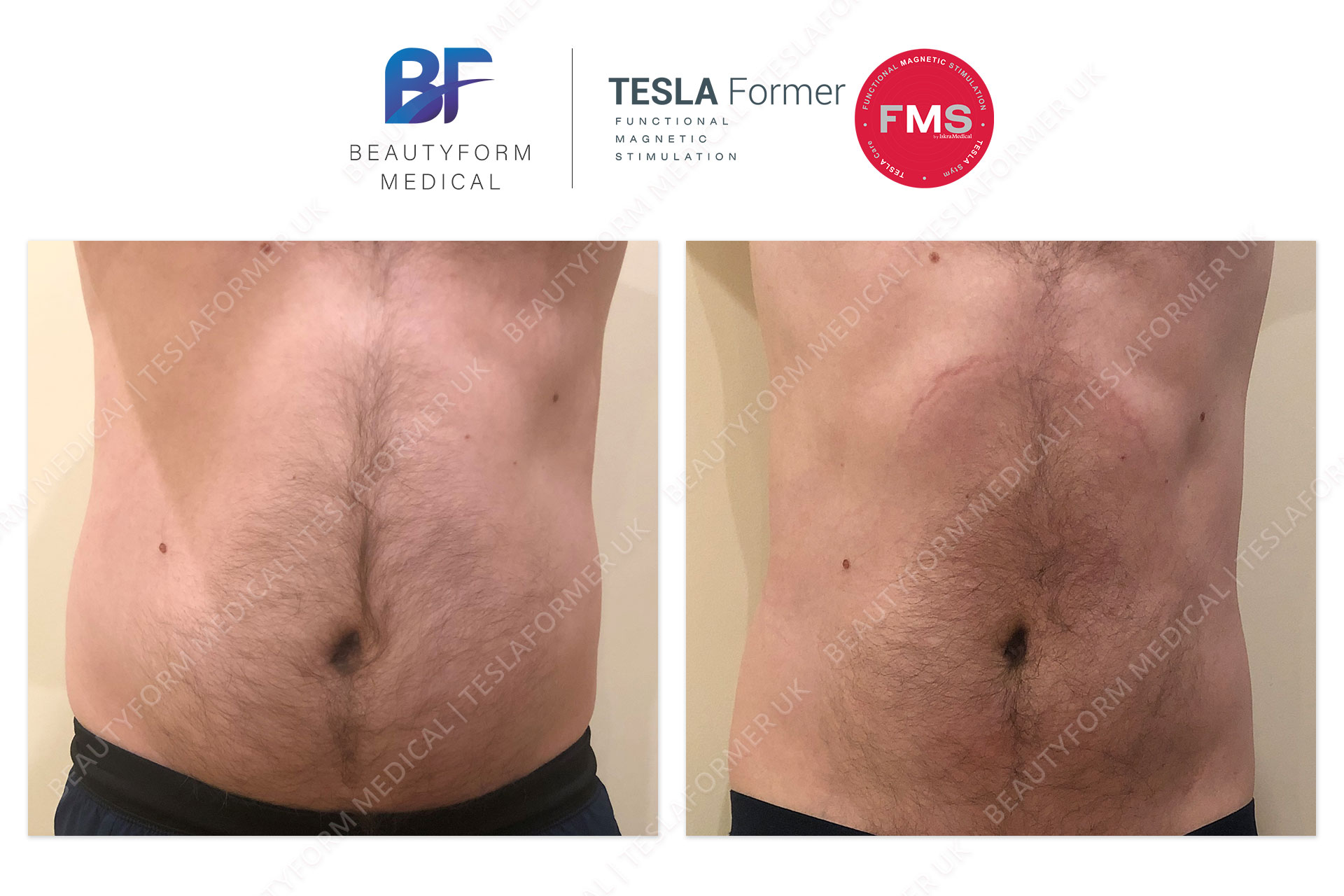 Tesla Former Abs Before and After